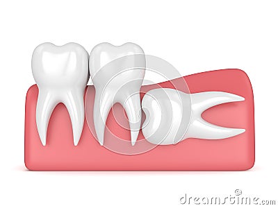 3d render of teeth with wisdom horizontal impaction Stock Photo