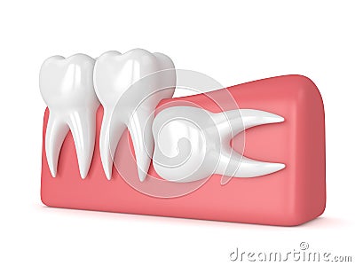 3d render of teeth with wisdom horizontal impaction Stock Photo