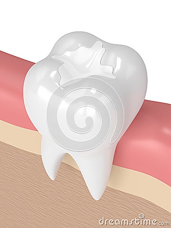 3d render of tooth with dental composite filling Stock Photo