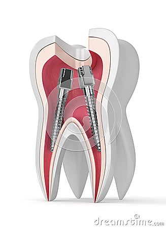 3d render of tooth with dental root canal posts Stock Photo