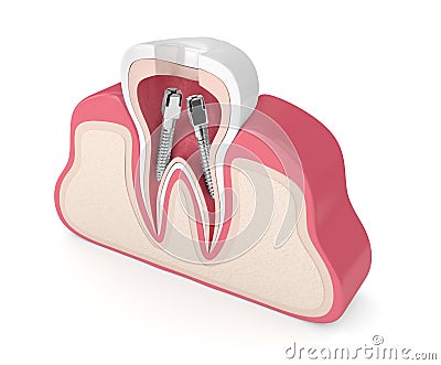 3d render of tooth with dental root canal posts Stock Photo