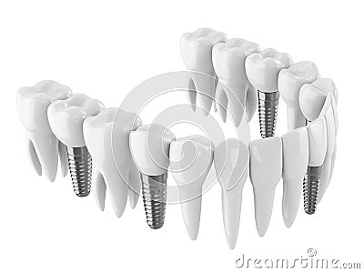 3d render of toothing with dental implants Stock Photo