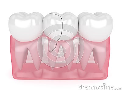 3d render of translucent gums with cracked tooth Stock Photo
