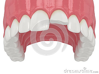 3d render of upper jaw with broken incisor tooth Stock Photo