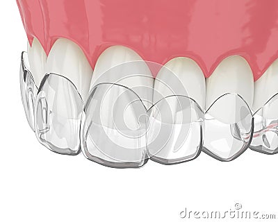 3d render of upper jaw with invisalign removable retainer Stock Photo