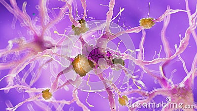 A alzheimer nerve cell Cartoon Illustration