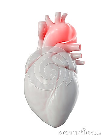 An aortic aneurysm Cartoon Illustration