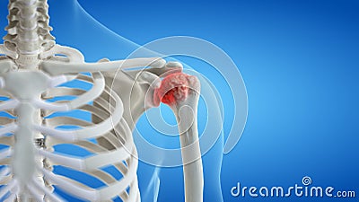 An arthritic shoulder joint Cartoon Illustration