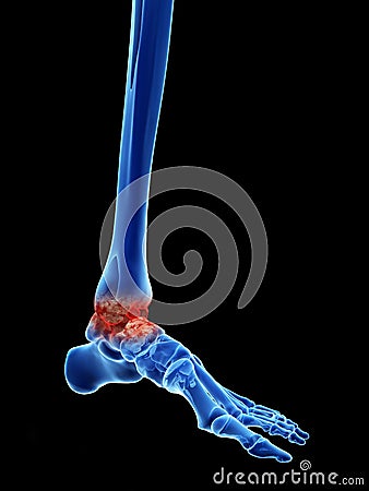 Arthrosis in the ankle Cartoon Illustration