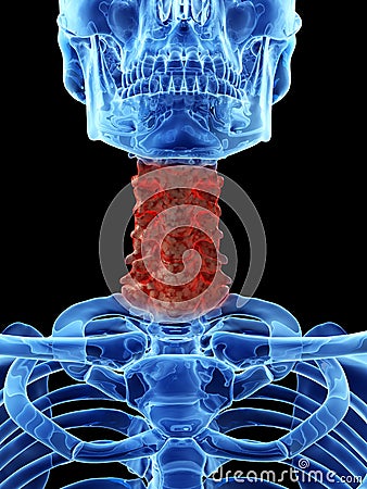 Arthrosis in the cervical Cartoon Illustration