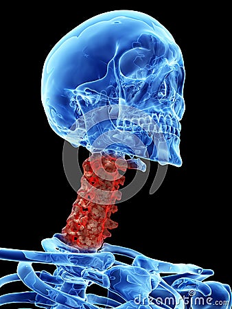 Arthrosis in the cervical spine Cartoon Illustration