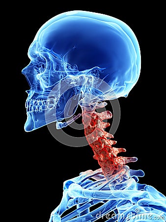 Arthrosis in the cervical spine Cartoon Illustration