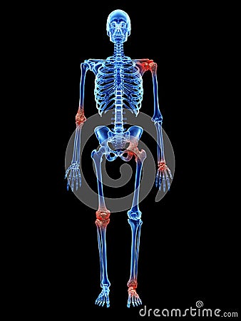 Arthrosis in the joints Cartoon Illustration