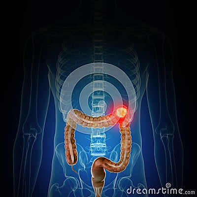 colon cancer Cartoon Illustration