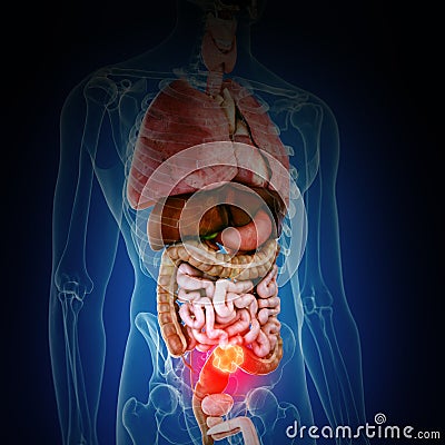 colon cancer Cartoon Illustration