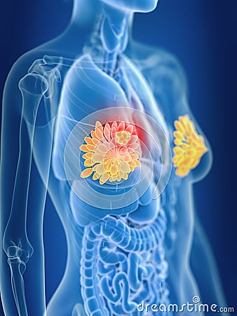 A females mammary glands cancer Cartoon Illustration