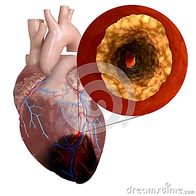 A heart attack Cartoon Illustration