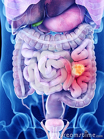 intestine cancer Cartoon Illustration