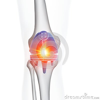 A knee replacement Cartoon Illustration