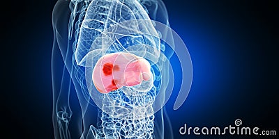 Liver tumors Cartoon Illustration