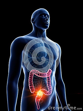 A mans colon tumor Cartoon Illustration