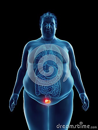 An obese mans bladder tumor Cartoon Illustration