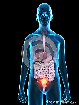 An old mans digestive tumor Cartoon Illustration