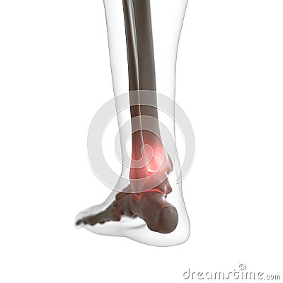 A painful ankle Cartoon Illustration