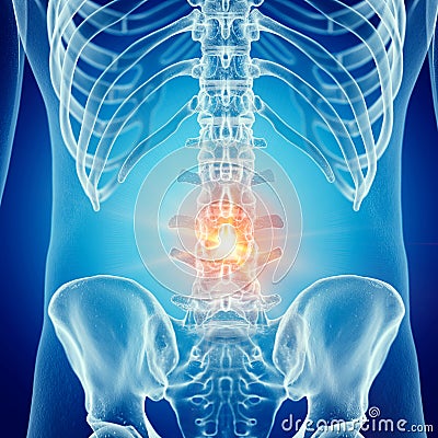 A painful lumbar spine Cartoon Illustration