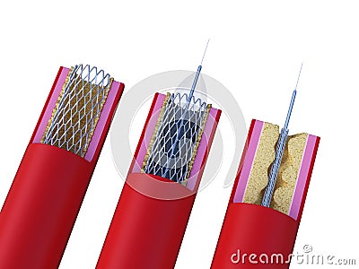 A stent being placed Cartoon Illustration