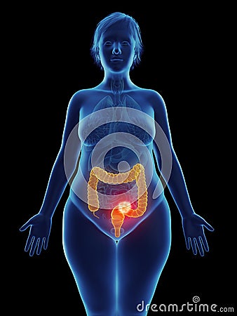 A tumor in a womans rectum Cartoon Illustration