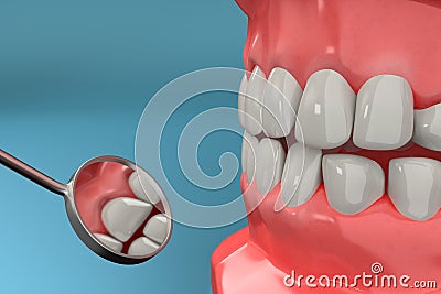 3D rendering from a dental check with a stomatoscope after brace remove, closeup Stock Photo