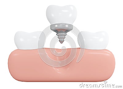 3D Rendering teeth with implant with gum tool icon cartoon style isolated on white. Cartoon Illustration