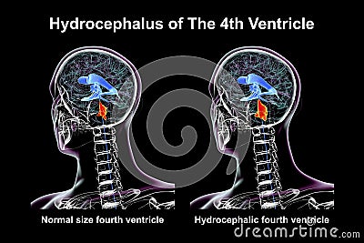 Enlargement of the fourth brain ventricle, 3D illustration Cartoon Illustration