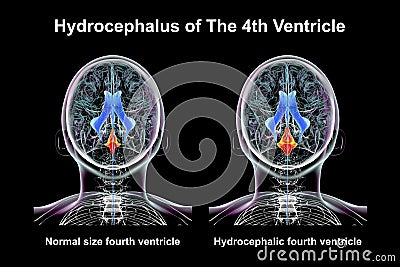 Enlargement of the fourth brain ventricle, 3D illustration Cartoon Illustration