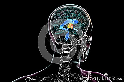 Enlargement of the third brain ventricle, 3D illustration Cartoon Illustration