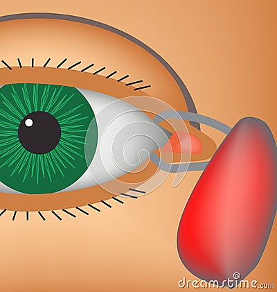 Dacryocyst. Inflammation of the lacrimal sac of the eye. The structure of the eye. Infographics. Vector illustration Vector Illustration