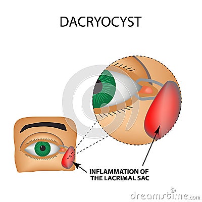 Dacryocyst. Inflammation of the lacrimal sac of the eye. The structure of the eye. Infographics. Vector illustration Vector Illustration