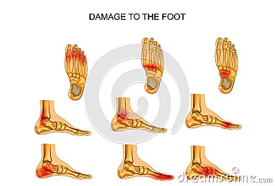 Damage to the foot Vector Illustration