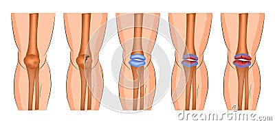 Damage to the knee joint Vector Illustration