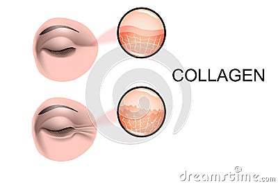 Damage to skin collagen. Wrinkles before and after Vector Illustration