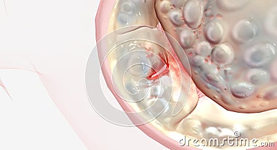 Damaged and malfunctioning mitral valve Stock Photo