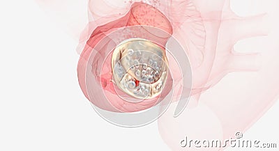 Damaged and malfunctioning mitral valve Stock Photo