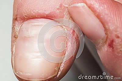 Damaged skin on the finger, burrs, macro Stock Photo