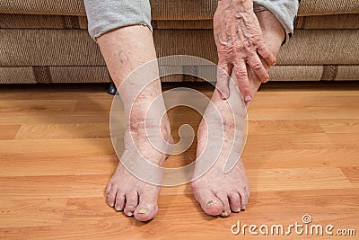 Damaged toes and wrinkled hand Stock Photo