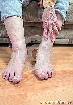 Damaged toes and wrinkled hand Stock Photo