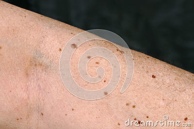 Dangerous or harmless pigment spots on the skin Stock Photo