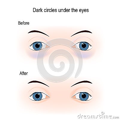 Dark circles under the eyes Vector Illustration