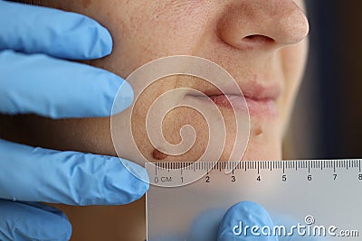 Dark wart on woman& x27;s face with ruler Stock Photo