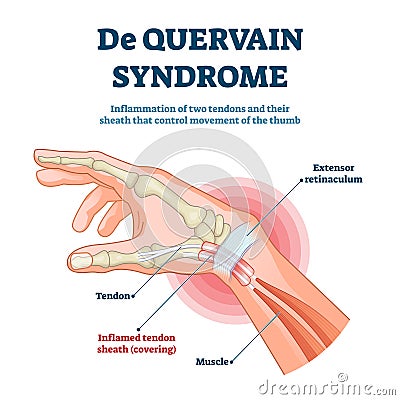 De Quervain syndrome vector illustration. Labeled thumb inflammation scheme Vector Illustration